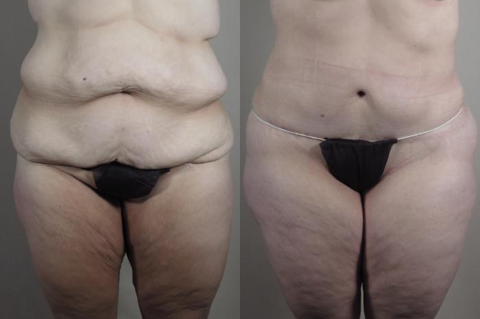 Tummy Tuck Case 1319 Before & After Front | Paramus, New Jersey | Parker Center for Plastic Surgery