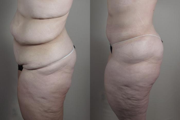 Tummy Tuck Case 1319 Before & After Left Side | Paramus, New Jersey | Parker Center for Plastic Surgery
