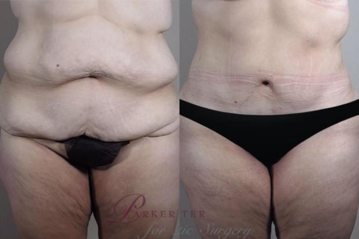 Tummy Tuck Case 1333 Before & After Front | Paramus, New Jersey | Parker Center for Plastic Surgery