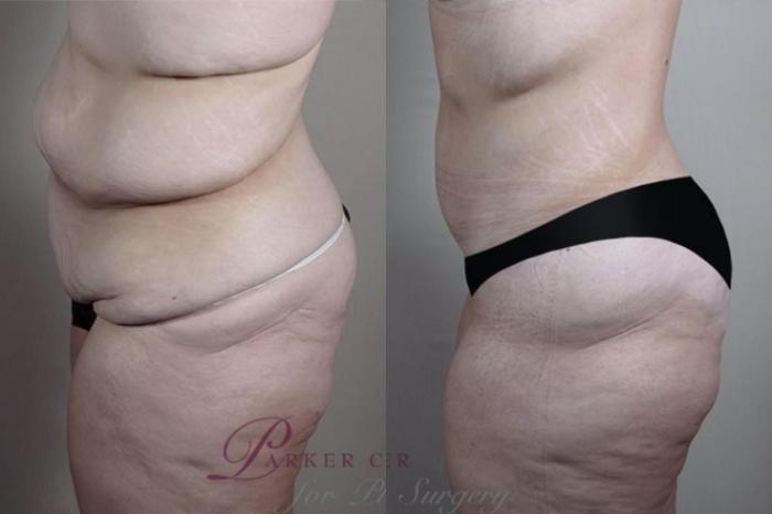 Tummy Tuck Case 1333 Before & After Left Side | Paramus, New Jersey | Parker Center for Plastic Surgery
