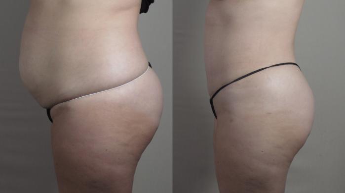 Tummy Tuck Case 1362 Before & After 1 week  | Paramus, New Jersey | Parker Center for Plastic Surgery