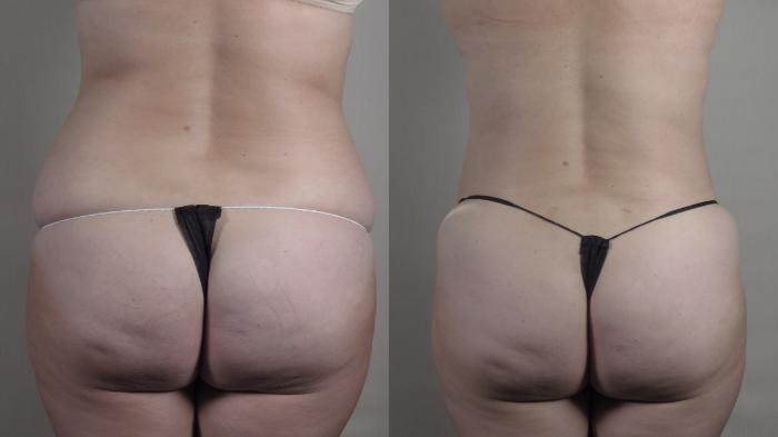 Tummy Tuck Case 1362 Before & After months  | Paramus, New Jersey | Parker Center for Plastic Surgery