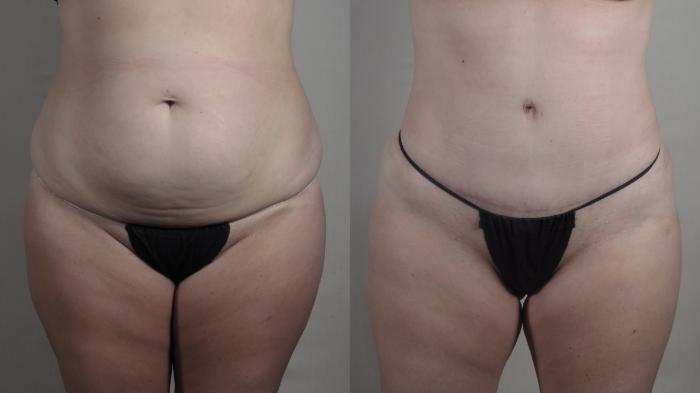 Tummy Tuck Case 1362 Before & After pre op  | Paramus, New Jersey | Parker Center for Plastic Surgery