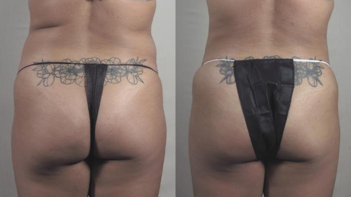 Tummy Tuck Case 1371 Before & After Back | Paramus, New Jersey | Parker Center for Plastic Surgery