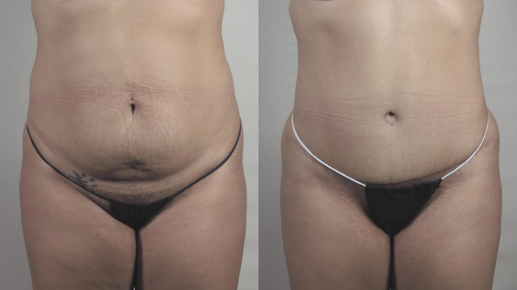 Tummy Tuck Case 1371 Before & After Front | Paramus, New Jersey | Parker Center for Plastic Surgery