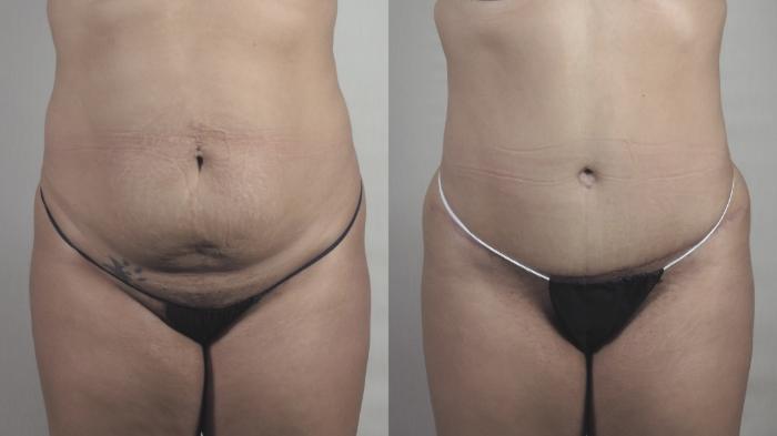 Tummy Tuck Case 1371 Before & After Front | Paramus, New Jersey | Parker Center for Plastic Surgery