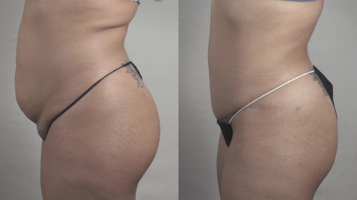 Tummy Tuck Case 1371 Before & After Left Side | Paramus, New Jersey | Parker Center for Plastic Surgery