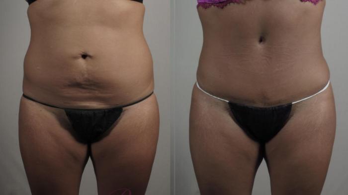 Tummy Tuck Case 1381 Before & After Front | Paramus, New Jersey | Parker Center for Plastic Surgery