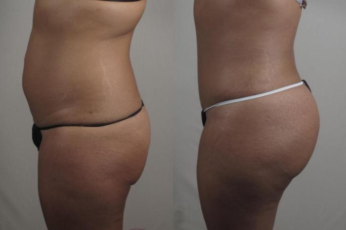 Tummy Tuck Case 1381 Before & After Left Side | Paramus, New Jersey | Parker Center for Plastic Surgery