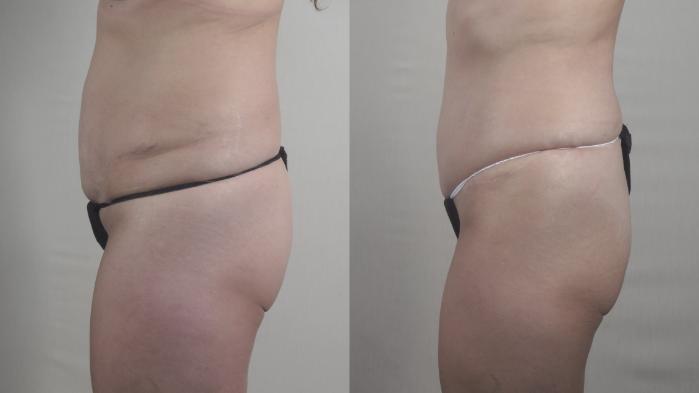 Tummy Tuck Case 1400 Before & After side view | Paramus, New Jersey | Parker Center for Plastic Surgery