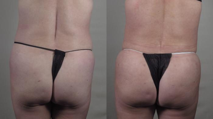 Tummy Tuck Case 1417 Before & After Back | Paramus, New Jersey | Parker Center for Plastic Surgery