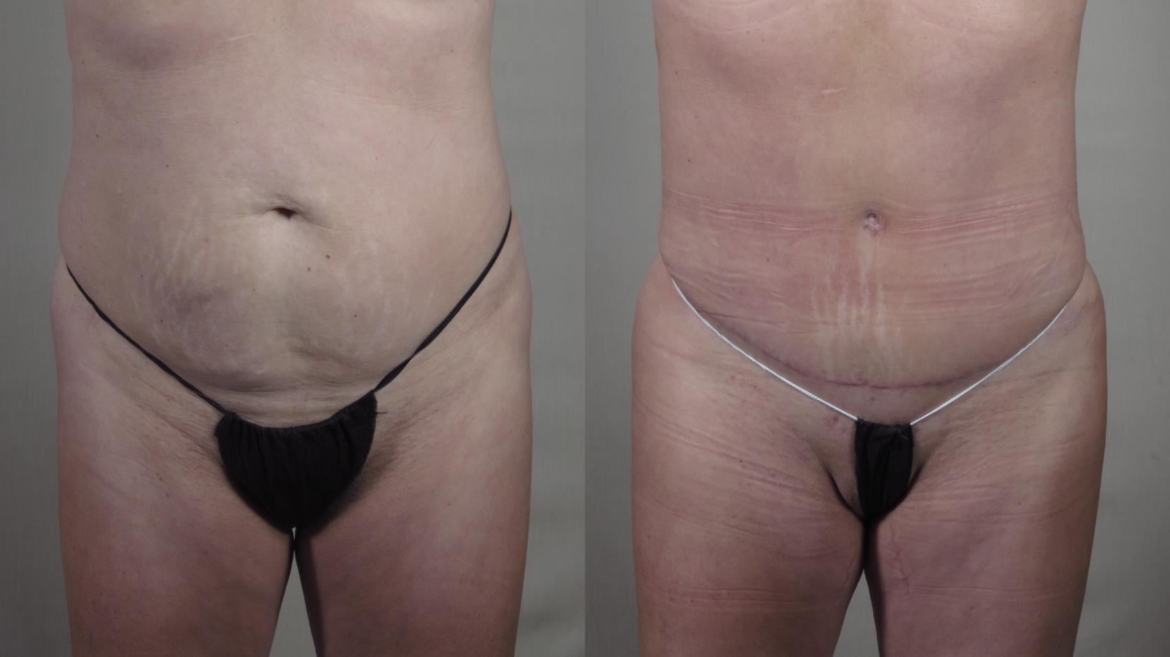 Tummy Tuck Case 1417 Before & After Front | Paramus, New Jersey | Parker Center for Plastic Surgery