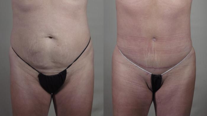 Tummy Tuck Case 1417 Before & After Front | Paramus, New Jersey | Parker Center for Plastic Surgery