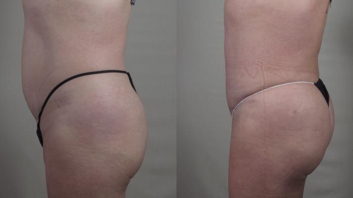 Tummy Tuck Case 1417 Before & After Side view | Paramus, New Jersey | Parker Center for Plastic Surgery