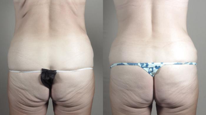 Tummy Tuck Case 1472 Before & After Back | Paramus, New Jersey | Parker Center for Plastic Surgery