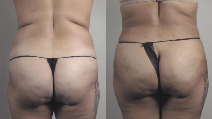 Liposuction Case 1482 Before & After Back | Paramus, New Jersey | Parker Center for Plastic Surgery