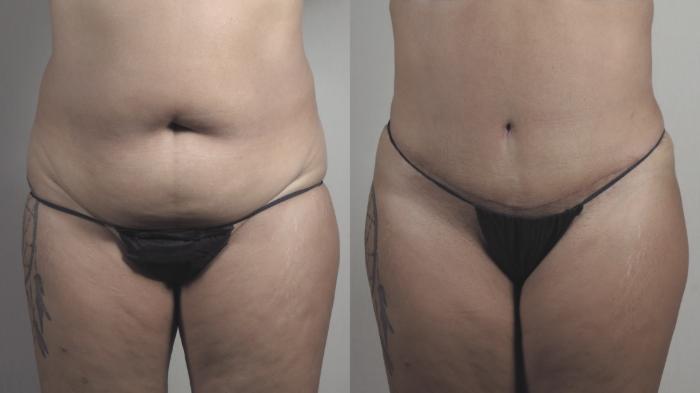 Liposuction Case 1482 Before & After Front | Paramus, New Jersey | Parker Center for Plastic Surgery