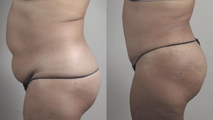 Liposuction Case 1482 Before & After Left Side | Paramus, New Jersey | Parker Center for Plastic Surgery