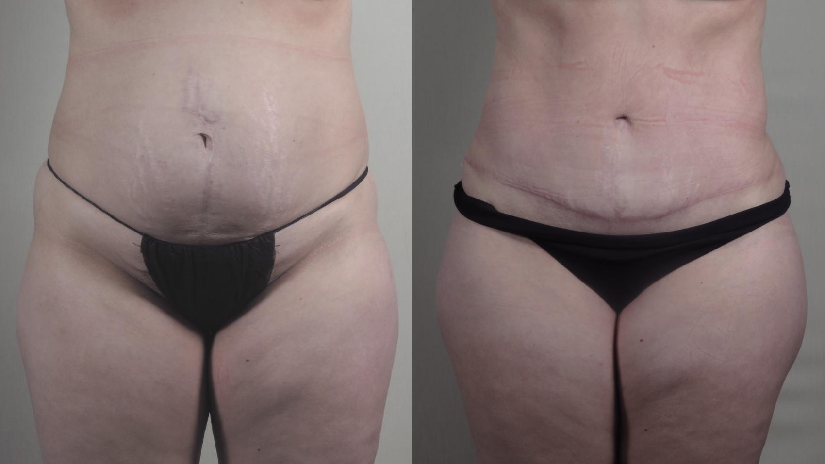 Tummy Tuck Case 1515 Before & After Front | Paramus, New Jersey | Parker Center for Plastic Surgery