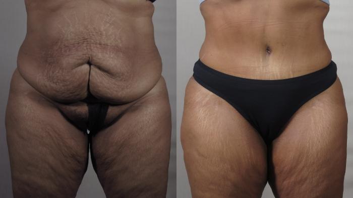 Tummy Tuck Case 1539 Before & After Front | Paramus, New Jersey | Parker Center for Plastic Surgery