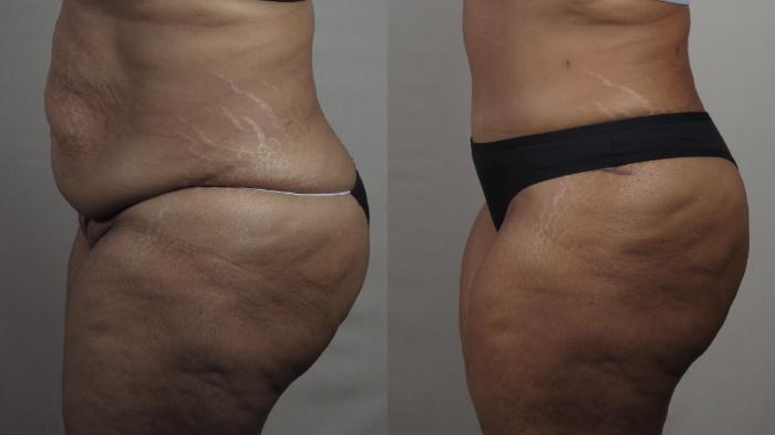 Tummy Tuck Case 1539 Before & After Left Side | Paramus, New Jersey | Parker Center for Plastic Surgery