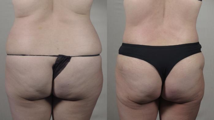 Tummy Tuck Case 1543 Before & After Back | Paramus, New Jersey | Parker Center for Plastic Surgery