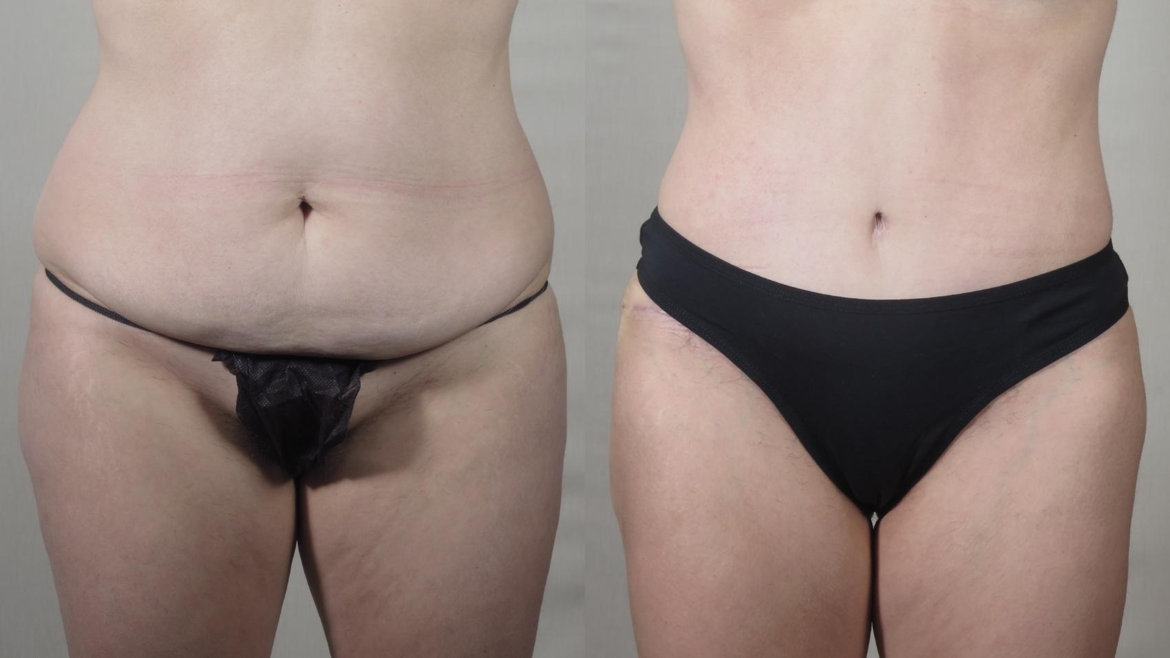 Tummy Tuck Case 1543 Before & After Front | Paramus, New Jersey | Parker Center for Plastic Surgery