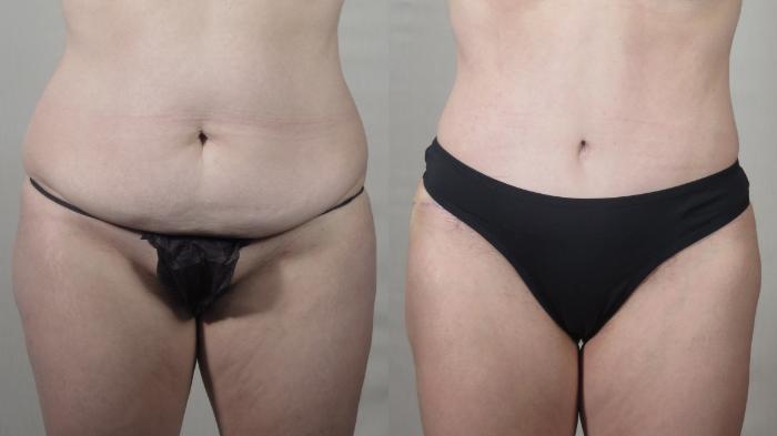 Tummy Tuck Case 1543 Before & After Front | Paramus, New Jersey | Parker Center for Plastic Surgery