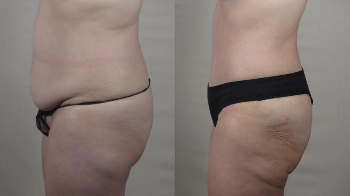 Tummy Tuck Case 1543 Before & After Left Side | Paramus, New Jersey | Parker Center for Plastic Surgery