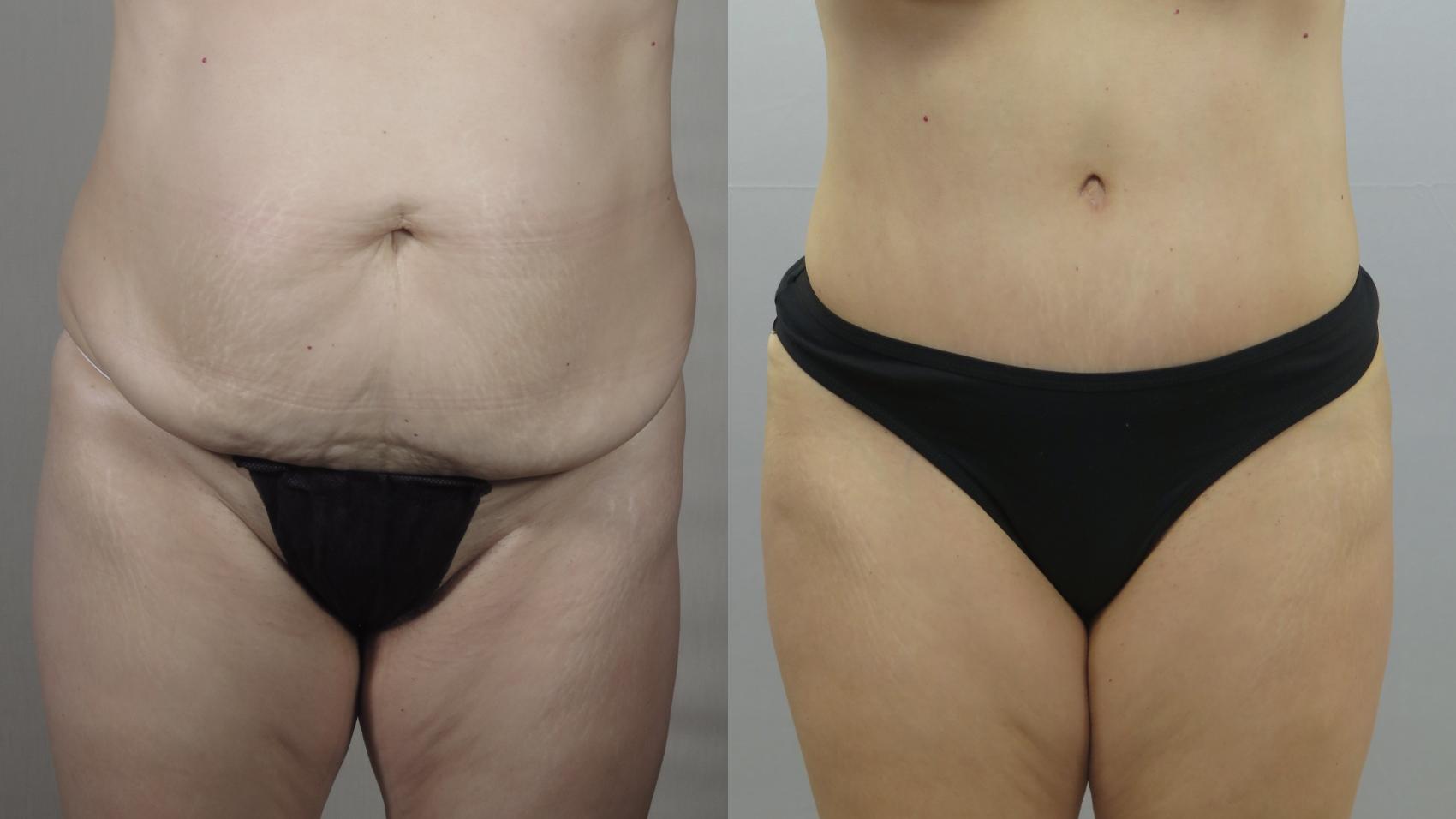 Tummy Tuck Case 1557 Before & After Front | Paramus, New Jersey | Parker Center for Plastic Surgery