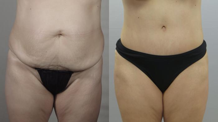Tummy Tuck Case 1557 Before & After Front | Paramus, New Jersey | Parker Center for Plastic Surgery