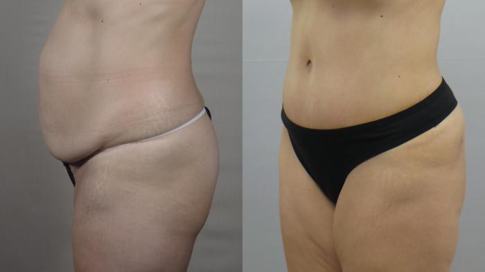 Tummy Tuck Case 1557 Before & After Left Side | Paramus, New Jersey | Parker Center for Plastic Surgery