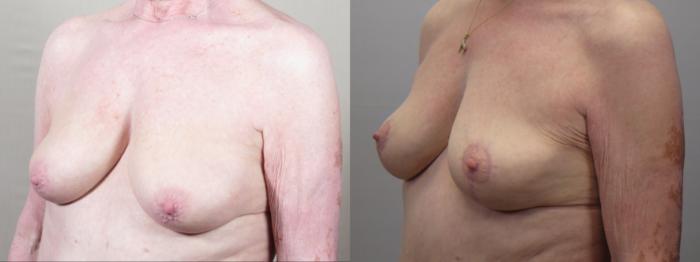 Tummy Tuck Case 1558 Before & After breast 2 | Paramus, New Jersey | Parker Center for Plastic Surgery
