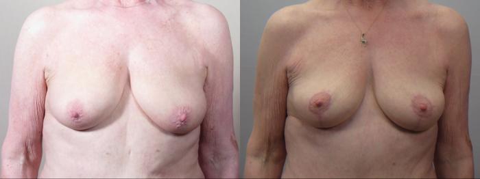 Tummy Tuck Case 1558 Before & After Breast | Paramus, New Jersey | Parker Center for Plastic Surgery