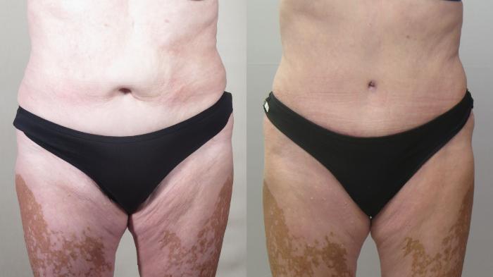 Tummy Tuck Case 1558 Before & After Front | Paramus, New Jersey | Parker Center for Plastic Surgery
