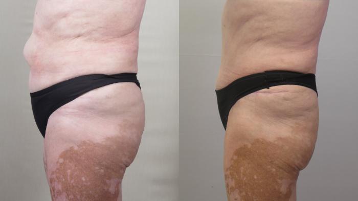 Tummy Tuck Case 1558 Before & After Left Side | Paramus, New Jersey | Parker Center for Plastic Surgery