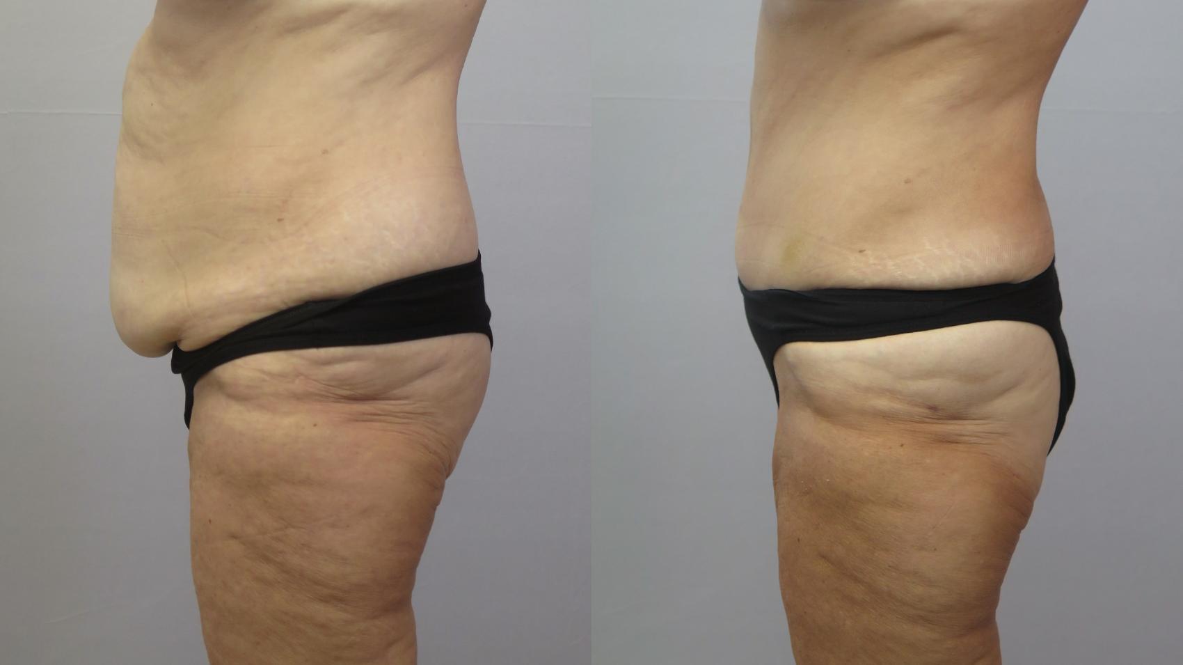 Tummy Tuck Case 1612 Before & After Left Side | Paramus, New Jersey | Parker Center for Plastic Surgery