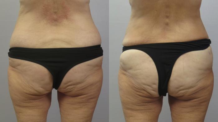 Tummy Tuck Case 1621 Before & After Back | Paramus, New Jersey | Parker Center for Plastic Surgery