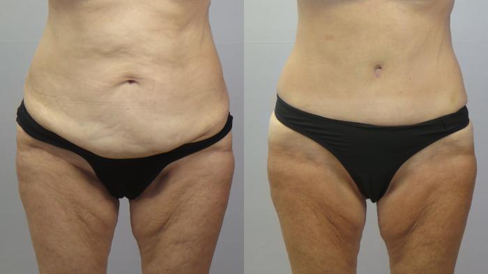 Tummy Tuck Case 1621 Before & After Front | Paramus, New Jersey | Parker Center for Plastic Surgery
