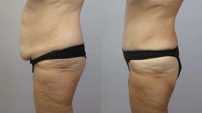 Tummy Tuck Case 1621 Before & After Left Side | Paramus, New Jersey | Parker Center for Plastic Surgery
