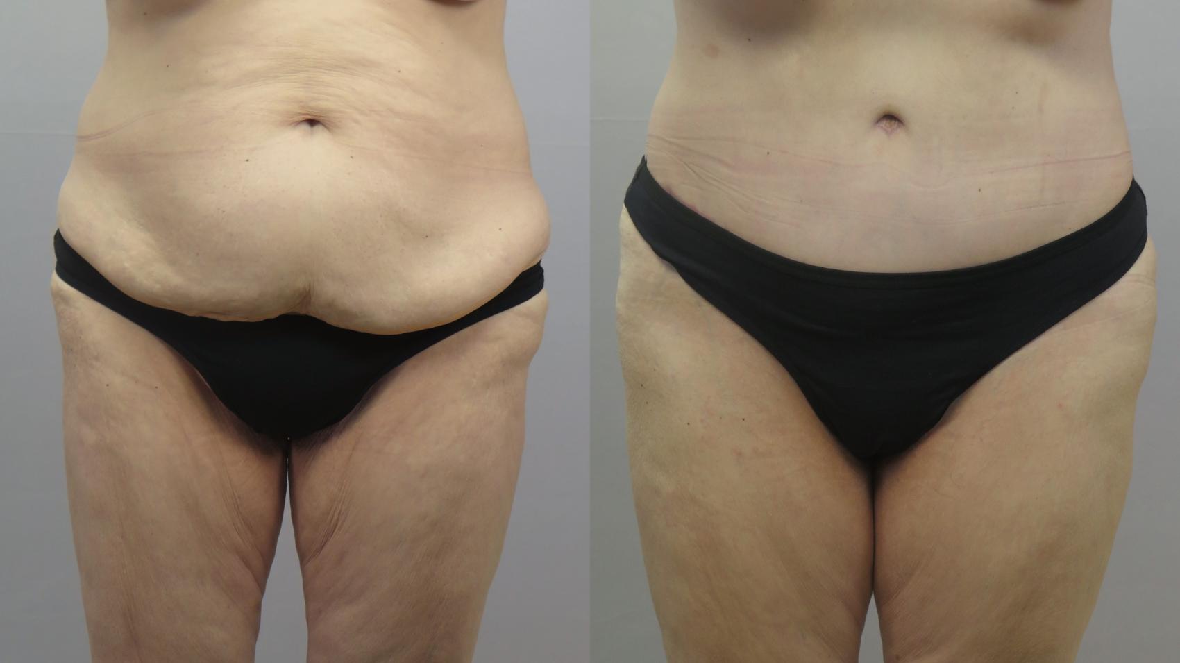 Tummy Tuck Case 1632 Before & After Front | Paramus, New Jersey | Parker Center for Plastic Surgery