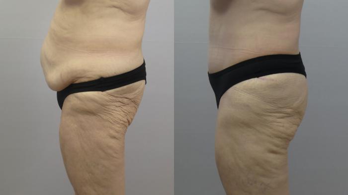 Tummy Tuck Case 1632 Before & After Left Side | Paramus, New Jersey | Parker Center for Plastic Surgery