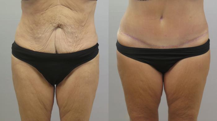 Tummy Tuck Case 1645 Before & After Front | Paramus, New Jersey | Parker Center for Plastic Surgery