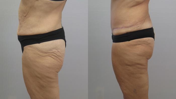 Tummy Tuck Case 1645 Before & After Left Side | Paramus, New Jersey | Parker Center for Plastic Surgery