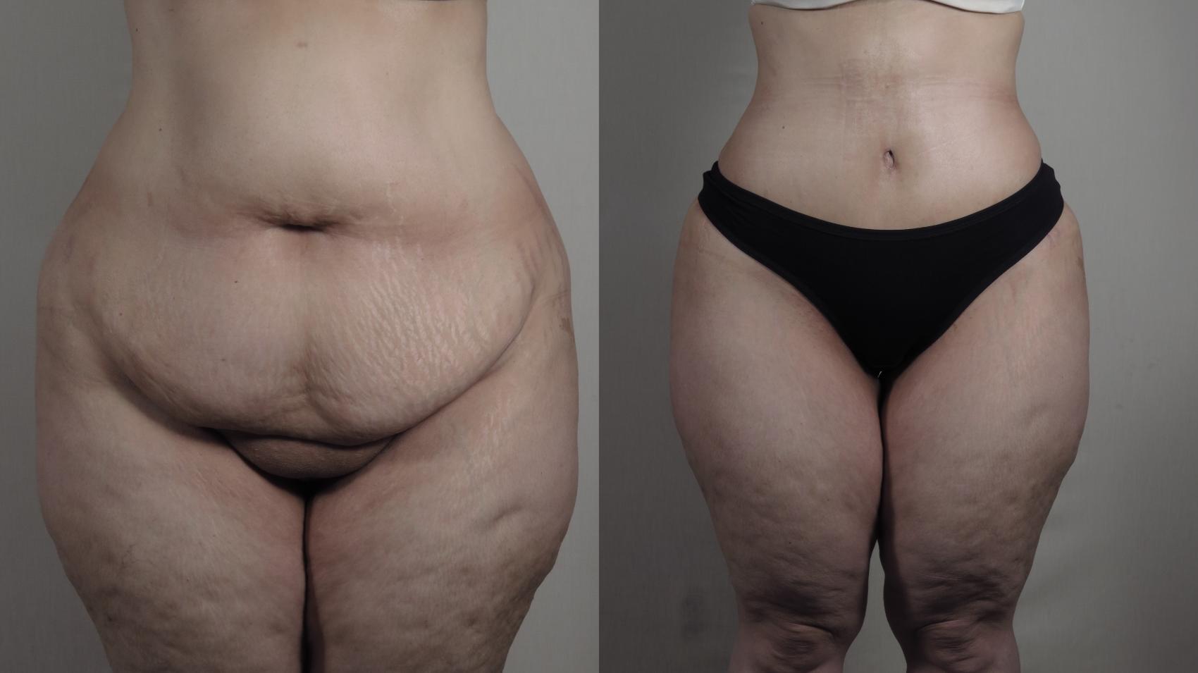 Tummy Tuck Case 1650 Before & After Front | Paramus, New Jersey | Parker Center for Plastic Surgery