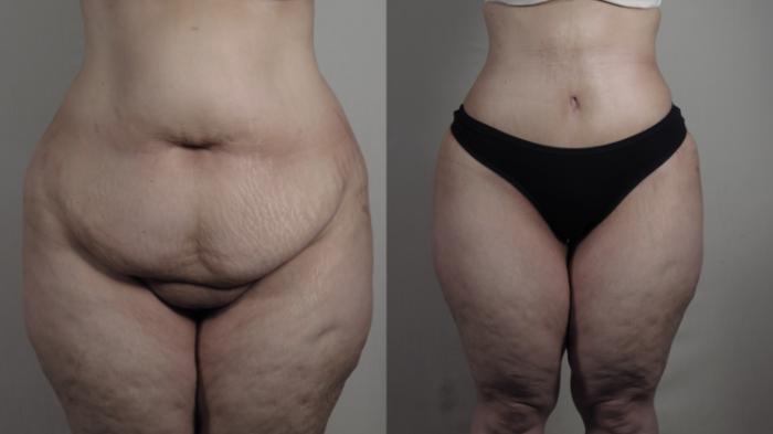 Tummy Tuck Case 1650 Before & After Front | Paramus, New Jersey | Parker Center for Plastic Surgery