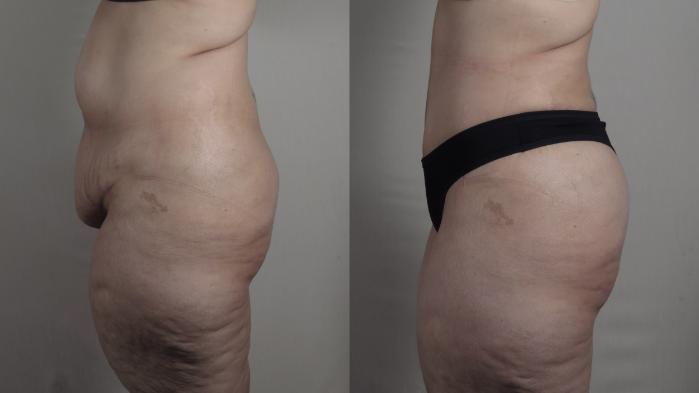 Tummy Tuck Case 1650 Before & After Left Side | Paramus, New Jersey | Parker Center for Plastic Surgery