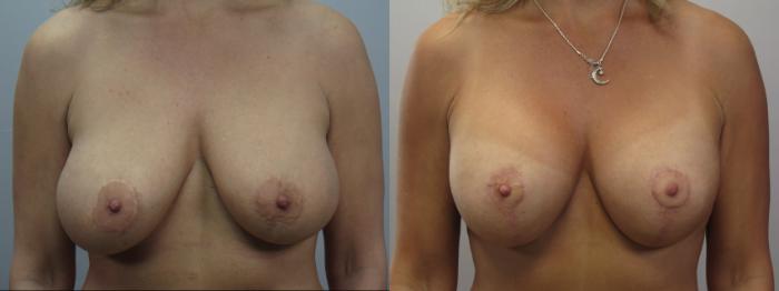 Tummy Tuck Case 1655 Before & After 1 | Paramus, New Jersey | Parker Center for Plastic Surgery