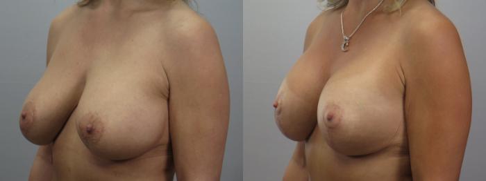Tummy Tuck Case 1655 Before & After 2 | Paramus, New Jersey | Parker Center for Plastic Surgery