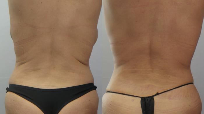 Tummy Tuck Case 1655 Before & After Back | Paramus, New Jersey | Parker Center for Plastic Surgery